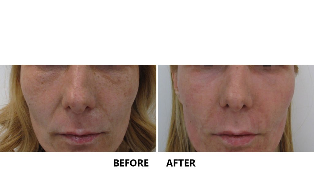 Laser eCO2 Fractionat: Rejuvenare Faciala | DermaBeauty Clinique