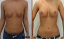 Marirea sanilor cu implant (metoda tri-axiala)1 Marirea sanilor cu implant (metoda tri-axiala)1