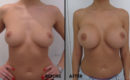 Marirea sanilor cu implant (metoda tri-axiala)2 Marirea sanilor cu implant (metoda tri-axiala)2