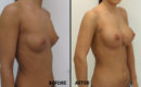Marirea sanilor cu implant (metoda tri-axiala)4 Marirea sanilor cu implant (metoda tri-axiala)4