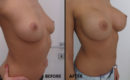 Marirea sanilor cu implant (metoda tri-axiala)5 Marirea sanilor cu implant (metoda tri-axiala)5