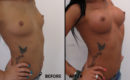 Marirea sanilor cu implant (metoda tri-axiala)6 Marirea sanilor cu implant (metoda tri-axiala)6