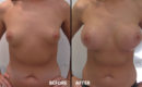 Marirea sanilor cu implant1 Marirea sanilor cu implant1