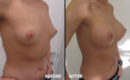Marirea sanilor cu implant10 Marirea sanilor cu implant10