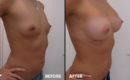 Marirea sanilor cu implant11 Marirea sanilor cu implant11