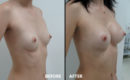 Marirea sanilor cu implant13 Marirea sanilor cu implant13