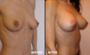 Marirea sanilor cu implant15 Marirea sanilor cu implant15
