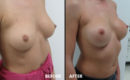 Marirea sanilor cu implant16 Marirea sanilor cu implant16