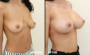Marirea sanilor cu implant17 Marirea sanilor cu implant17