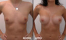 Marirea sanilor cu implant2 Marirea sanilor cu implant2