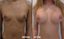 Marirea sanilor cu implant2 Marirea sanilor cu implant2