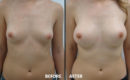 Marirea sanilor cu implant3 Marirea sanilor cu implant3