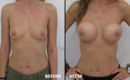 Marirea sanilor cu implant3 Marirea sanilor cu implant3