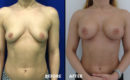 Marirea sanilor cu implant4 Marirea sanilor cu implant4