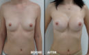 Marirea sanilor cu implant5 Marirea sanilor cu implant5