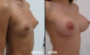Marirea sanilor cu implant5 Marirea sanilor cu implant5