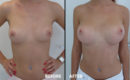 Marirea sanilor cu implant6 Marirea sanilor cu implant6