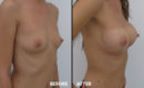 Marirea sanilor cu implant6 Marirea sanilor cu implant6