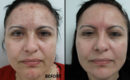 Peeling intermediar plus, in 3 etape1 Peeling intermediar plus, in 3 etape1