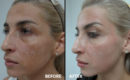 Peeling intermediar plus, in 3 etape11 Peeling intermediar plus, in 3 etape11