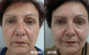 Peeling intermediar plus, in 3 etape12 Peeling intermediar plus, in 3 etape12