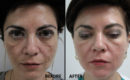 Peeling intermediar plus, in 3 etape2 Peeling intermediar plus, in 3 etape2