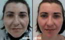 Peeling intermediar plus, in 3 etape3 Peeling intermediar plus, in 3 etape3