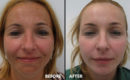 Peeling intermediar plus, in 3 etape4 Peeling intermediar plus, in 3 etape4