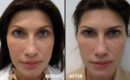 Peeling intermediar plus, in 3 etape7 Peeling intermediar plus, in 3 etape7