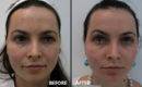 Peeling intermediar plus, in 3 etape8 Peeling intermediar plus, in 3 etape8