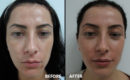 Peeling intermediar plus, in 3 etape9 Peeling intermediar plus, in 3 etape9