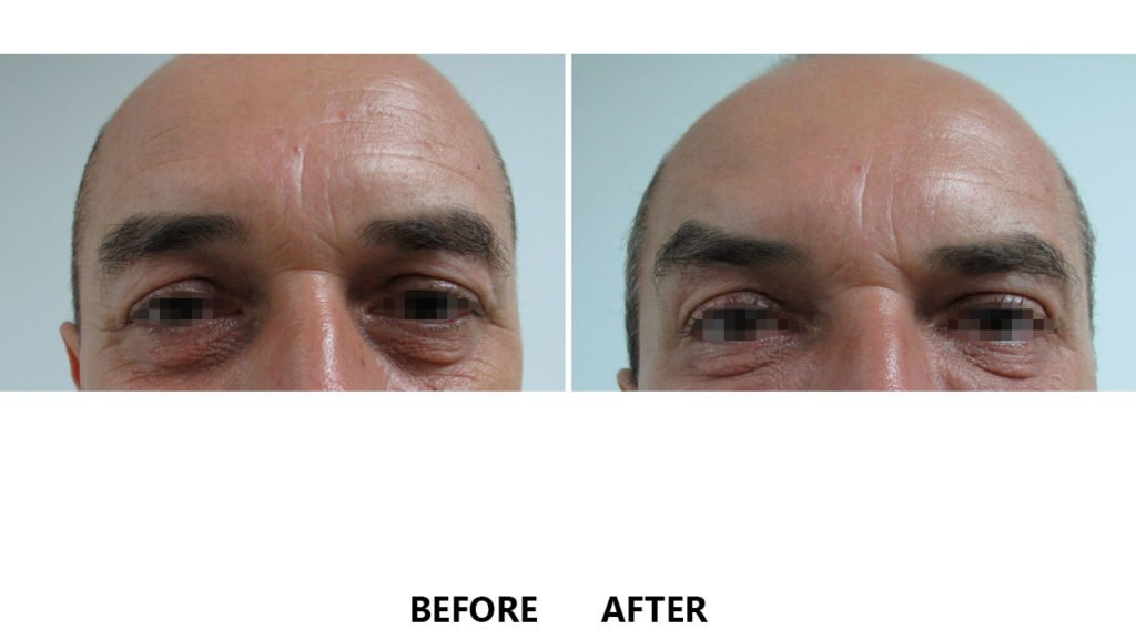 riduri intre sprancene botox cea mai bună mască anti-îmbătrânire pentru piele