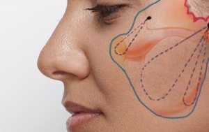 painful Tell Starting point Lifting Facial | Tratamente la Cele mai bune Preturi by Dr. Renert